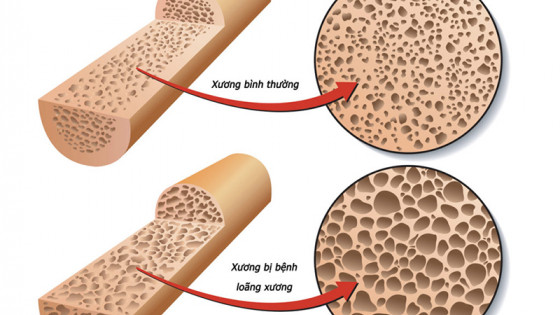 Thiếu vitamin D: "Căn bệnh âm thầm" dễ bị bỏ qua