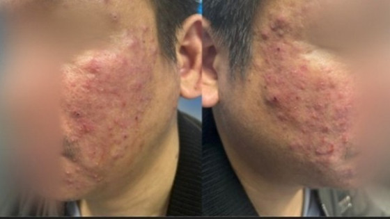 Viêm da mặt kéo dài, người bệnh bất ngờ phát hiện nhiễm ký sinh trùng Demodex