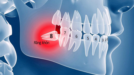 Những lưu ý quan trọng trước khi nhổ răng khôn