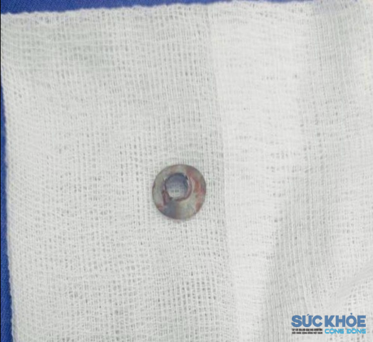 Cứu sống thợ xây bị đầu vít bắn xuyên má – cảnh báo nguy cơ tai nạn lao động