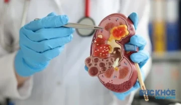 Trẻ em đối mặt biến chứng nguy hiểm từ thận hư kháng thuốc