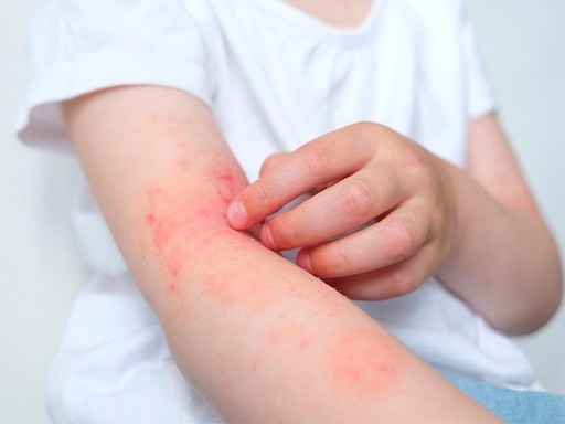 Chủ động phòng ngừa viêm da cơ địa để hạn chế tái phát