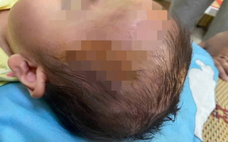 Bé gái 19 tháng tuổi ở Huế bị chó cắn nhiều vết thương nặng vùng đầu, mặt