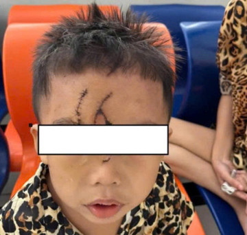 Phẫu thuật thành công cho bé trai 5 tuổi do bị chó béc-giê cắn rách nát vùng trán
