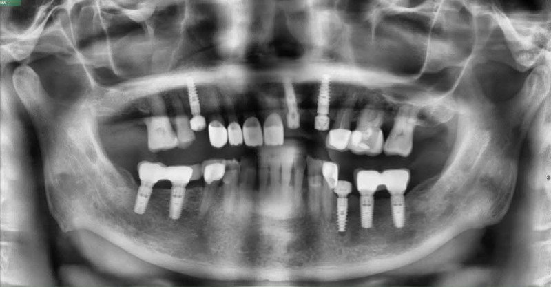 Nên lưu ý những yếu tố nào để giúp phục hồi sau khi cấy ghép răng implant