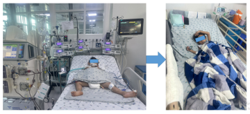 Bé trai 4 tuổi chọc ong vò vẽ bị đốt 35 mũi gây tổn thương đa cơ quan