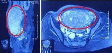 Phẫu thuật thành công lấy khối u tử cung dài hơn 30cm ra khỏi cơ thể bệnh nhân