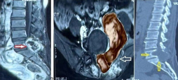 U quái ác "hình quả tạ" tái phát sau nhiều năm – ca bệnh hiếm gặp tại TP. Hồ Chí Minh