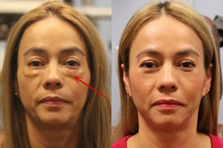 Làm thế nào để phân biệt filler thật và filler giả?