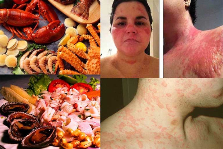 Dị ứng hải sản kéo dài bao lâu?