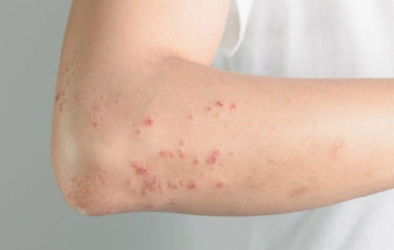 Người lớn mắc sởi có nguy hiểm không?