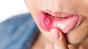Cách chữa loét miệng đơn giản mà hiệu quả
