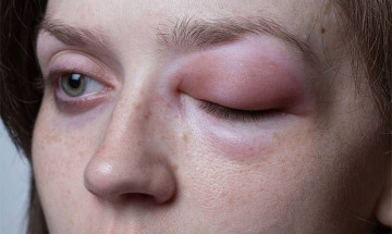 Những cách chữa sưng mắt do viêm mũi dị ứng