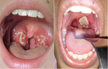 Bệnh bạch hầu: Nguyên nhân, triệu chứng, điều trị và phòng ngừa