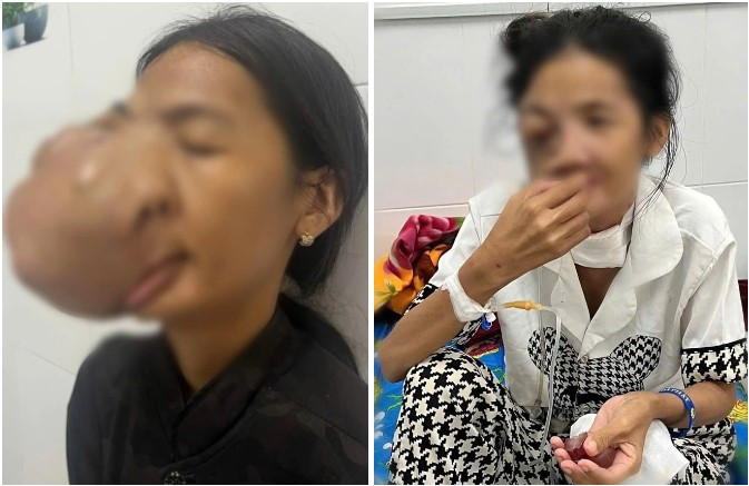 Mang khối u men răng khổng lồ suốt 10 năm, người phụ nữ được tái tạo toàn bộ hàm mặt