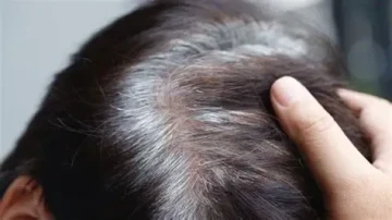 Có phòng ngừa tóc bạc sớm được không?