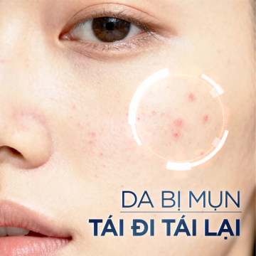 Đánh bay nỗi ám ảnh da dầu mụn tái phát với serum - "Trợ thủ" kiểm soát dầu thế hệ mới