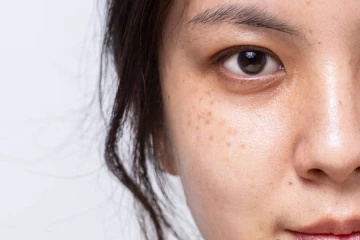 Phân biệt nám và tàn nhang