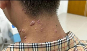 Cảnh báo: Đồng Nai ghi nhận ca đậu mùa khỉ đầu tiên, hiện chưa xác định được nguồn lây