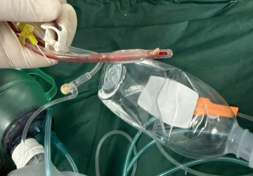 Bé gái 3 tuổi tử vong sau khi sặc thức ăn ở lớp