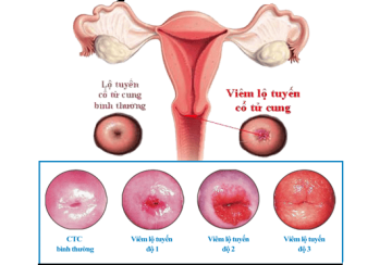 Viêm lộ tuyến cổ tử cung là gì?