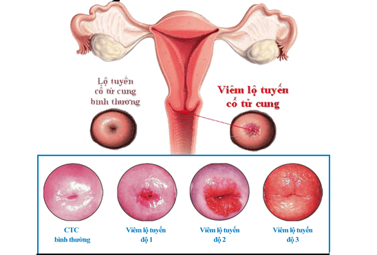 Viêm lộ tuyến cổ tử cung là gì?
