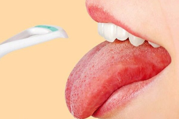 Dấu hiệu của lưỡi cảnh báo vấn đề về sức khỏe