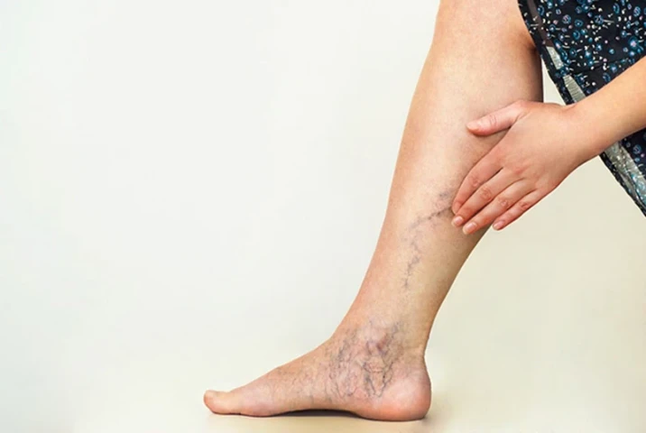 Giãn mao mạch có điều trị dứt điểm được không?