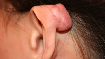 Cách điều trị sẹo lồi sau khi bấm lỗ tai