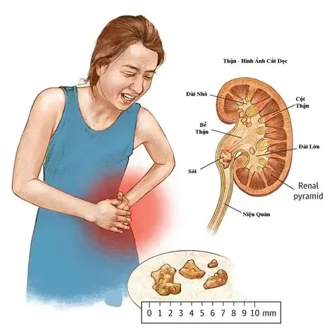 Sỏi thận: Điều trị thế nào để sạch sỏi và hạn chế tái phát?