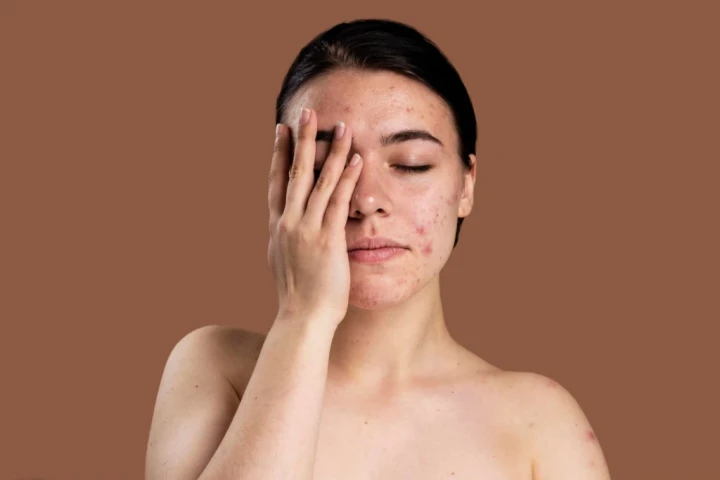 Vì sao bị mụn trứng cá dai dẳng?