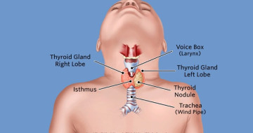 Trẻ em có bị bướu cổ không?