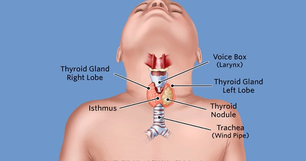 Trẻ em có bị bướu cổ không?