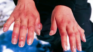 Bỏng lạnh là gì? Cách sơ cứu khi bị bỏng lạnh
