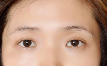 Điều trị rụng lông mày theo y học cổ truyền