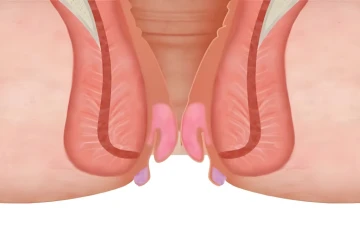 Người bị trĩ nhẹ có tự khỏi được không?