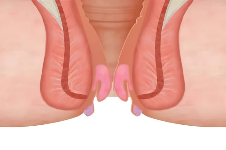 Người bị trĩ nhẹ có tự khỏi được không?