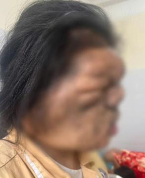Cô gái 19 tuổi được phẫu thuật sau 17 năm mang khối u khổng lồ vùng mặt