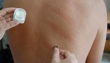 Dùng đồng bạc cạo gió có giúp giải cảm?