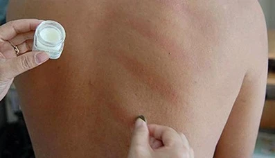 Dùng đồng bạc cạo gió có giúp giải cảm?