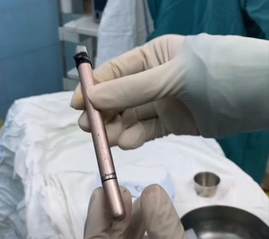 Gắp thành công cây bút bị mắc kẹt trong bàng quang của một thiếu nữ