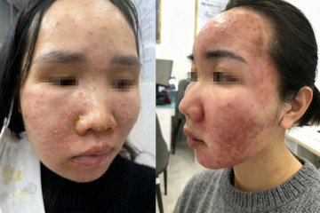 “Làm đẹp cấp tốc” đón Tết, cô gái hỏng cả khuôn mặt