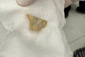 Ăn miến ngày Tết, bé gái bị mảnh xương mắc ở thực quản