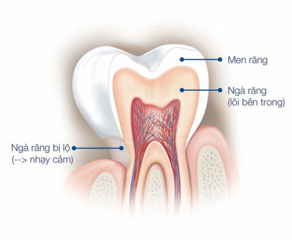 Vì sao bạn bị ê buốt chân răng?