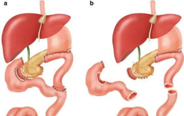 Điều trị thành công ca giãn tá tràng khổng lồ đầu tiên tại Việt Nam