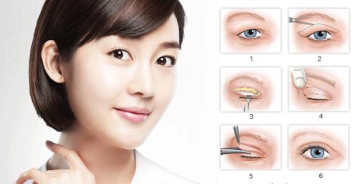 Mắt một mí: Bạn nên bấm mí hay cắt mí?