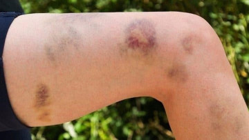 Dùng thuốc nam không rõ nguồn gốc, người phụ nữ mắc bệnh hiếm