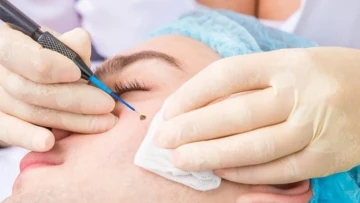 Tẩy nốt ruồi kiêng ăn gì để hạn chế sẹo?