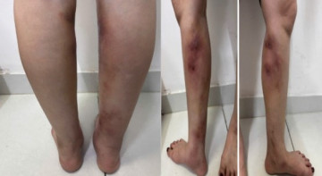 Cẳng chân người phụ nữ biến dạng do tiêm filler tại nhà, bác sĩ cảnh báo trào lưu độc hại