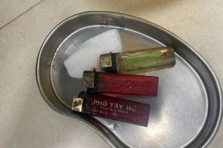 Phát hiện 3 chiếc bật lửa trong dạ dày người bệnh